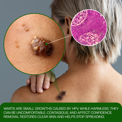 Timilk® ClinixClear Wart Remover Patch